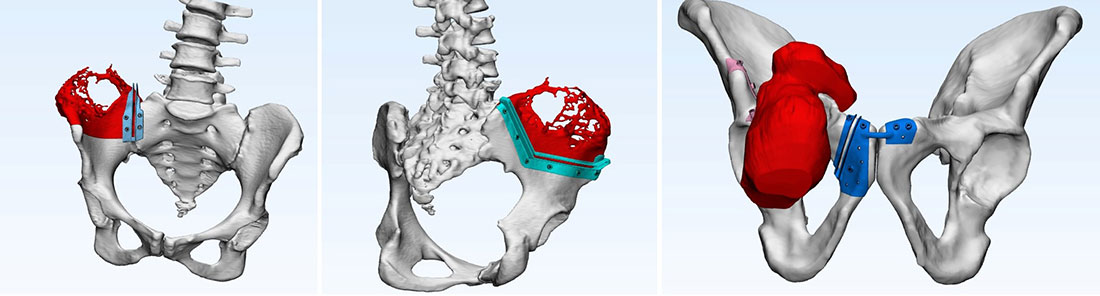 3D planning and patient-specific cutting guides improve the accuracy of bone tumor removal during complex limb-salvage surgery, especially for pelvic tumors 3D planning and patient-specific cutting guides improve the accuracy of bone tumor removal during complex limb-salvage surgery, especially for pelvic tumors