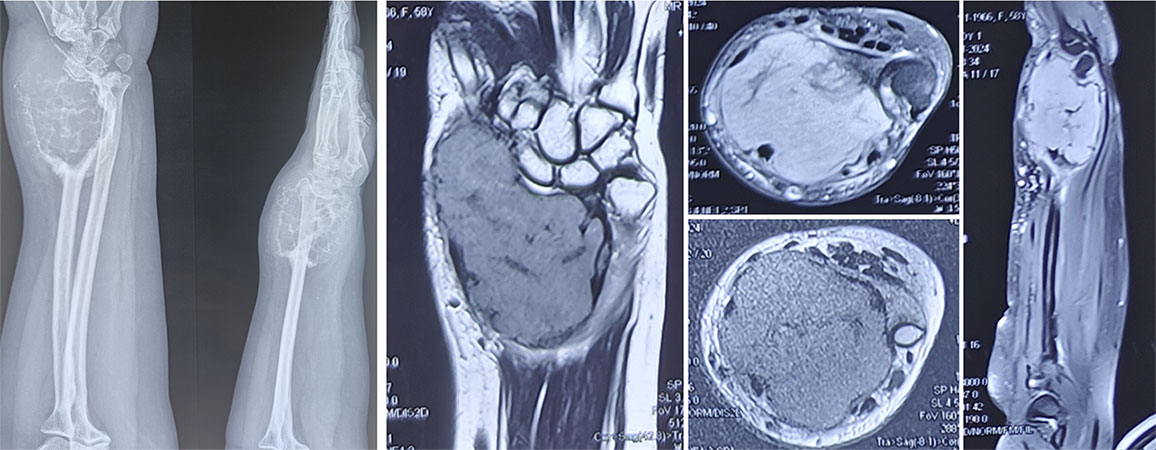Grade 3 giant cell tumor with extensive bone destruction Grade 3 giant cell tumor of bone showing extensive local bone destruction and soft-tissue involvement