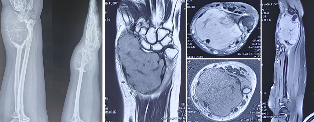 Grade 3 giant cell tumor with extensive bone destruction Grade 3 giant cell tumor of bone showing extensive local bone destruction and soft-tissue involvement