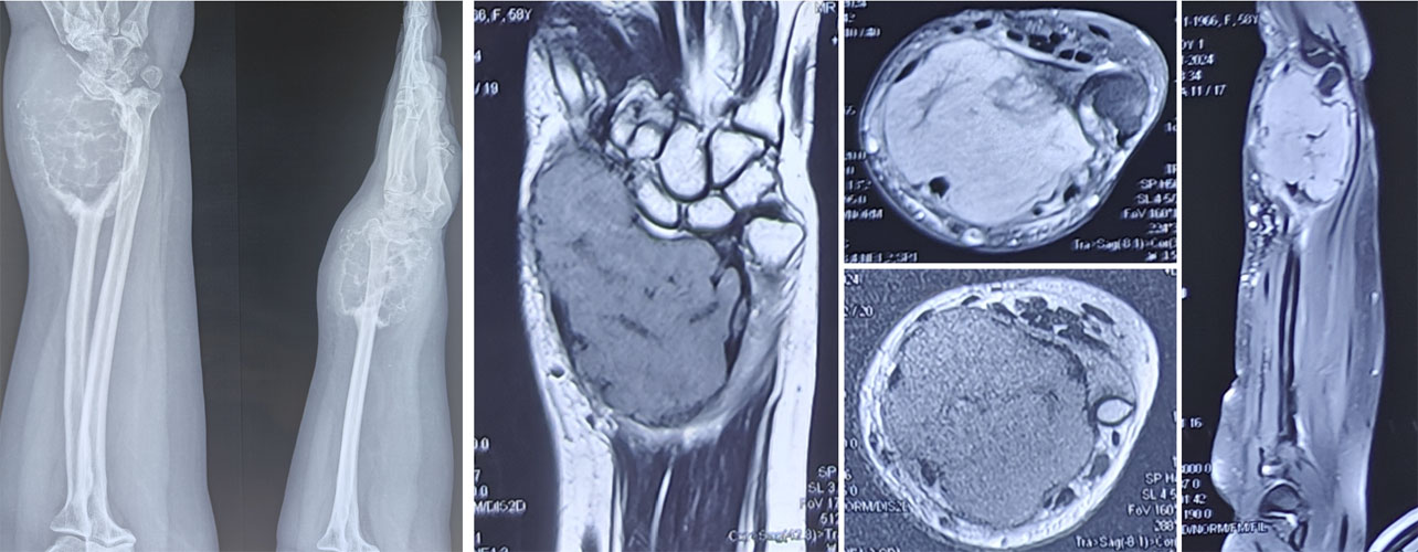 A Grade 3 giant cell tumor of bone with extensive local bone destruction and soft-tissue involvement A Grade 3 giant cell tumor of bone with extensive local bone destruction and soft-tissue involvement