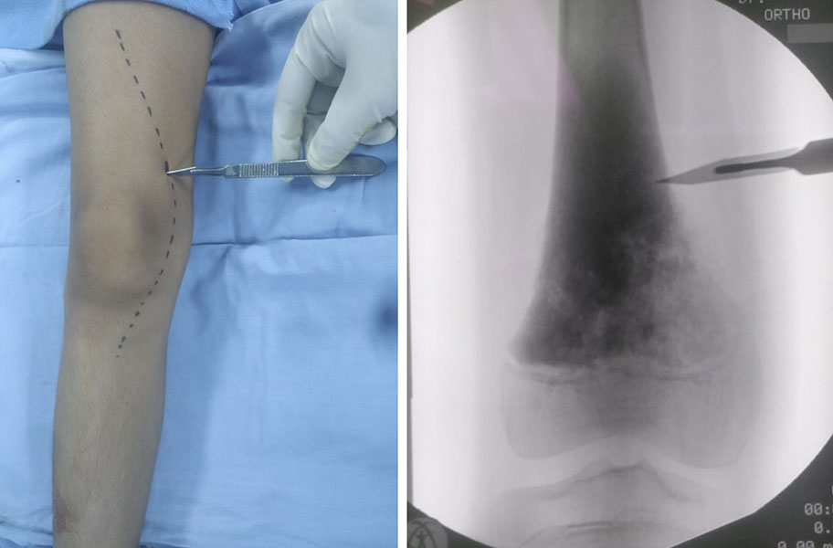 A carefully planned biopsy tract is aligned with the future surgical incision to facilitate safe tumor removal