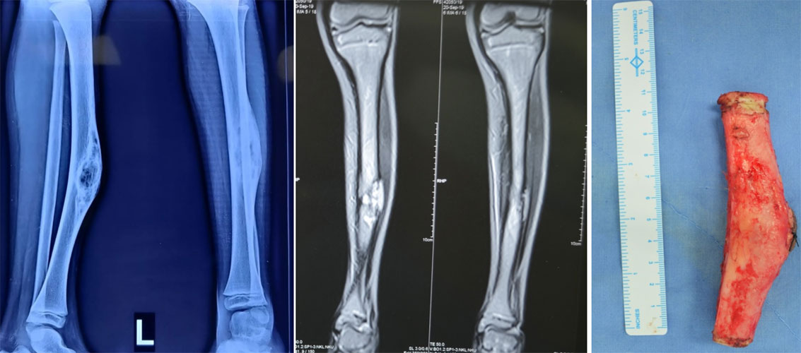 Adamantinoma of the tibia treated with wide surgical excision Adamantinoma of the tibia treated with wide surgical excision