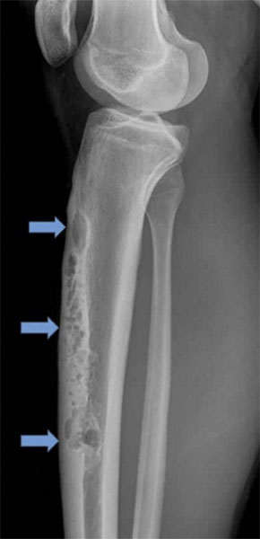 Adamantinoma of the tibia Adamantinoma of the tibia