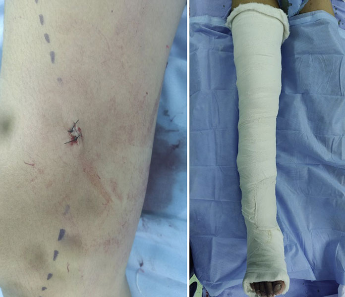 After biopsy, meticulous wound closure and limb immobilization help protect the biopsy site during healing