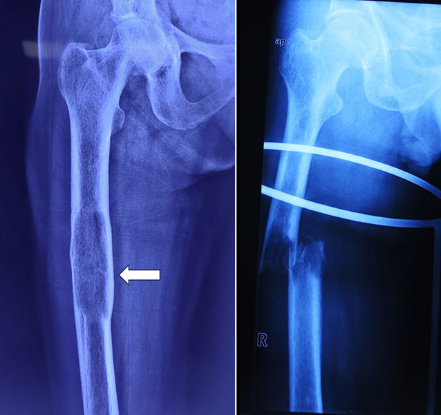 An impending fracture can become a complete pathological fracture if not treated in time An impending fracture can become a complete pathological fracture if not treated in time