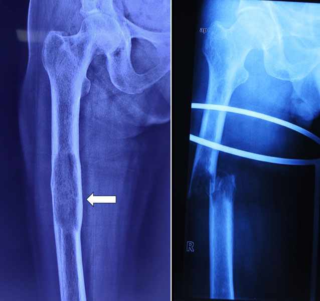 An impending pathological fracture in a weakened bone An impending pathological fracture in a weakened bone