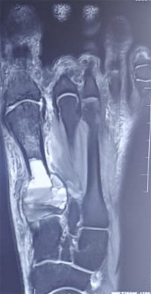 Aneurysmal bone cyst of the ankle and foot—a benign but locally aggressive bone lesion Aneurysmal bone cyst of the ankle and foot—a benign but locally aggressive bone lesion