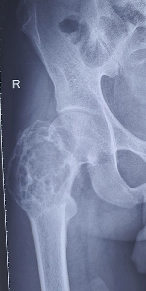 Aneurysmal bone cyst of the proximal femur, showing an expansile bone lesion around the hip Aneurysmal bone cyst of the proximal femur, showing an expansile bone lesion around the hip
