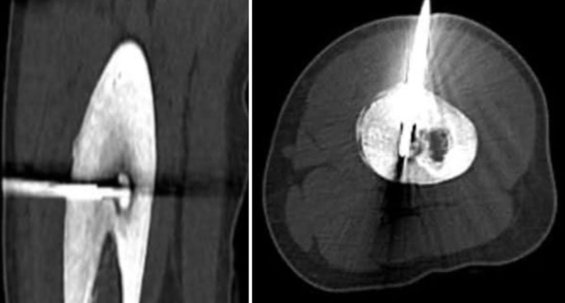 Biopsy of a bone tumor Biopsy of a bone tumor