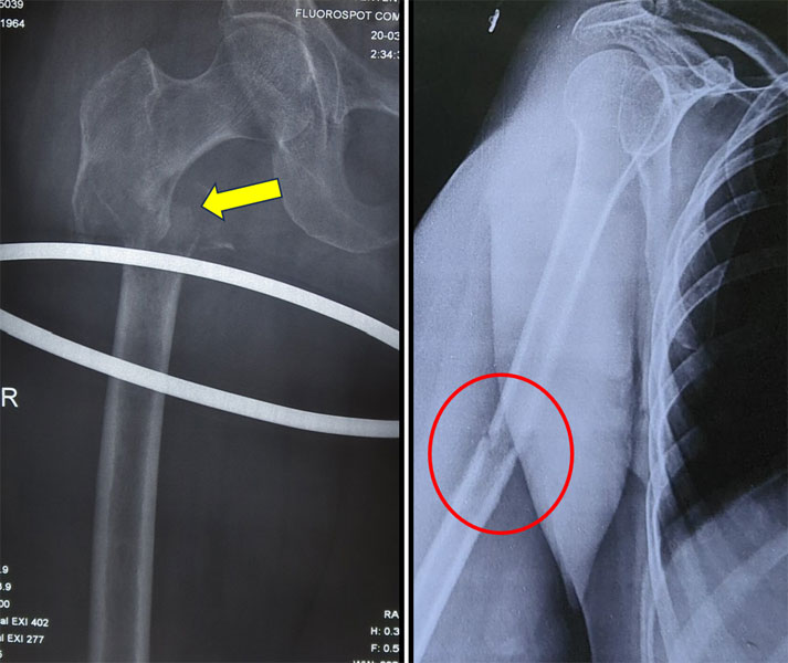Bone metastases in the femur and upper arm bone (humerus), common sites for pathological fractures