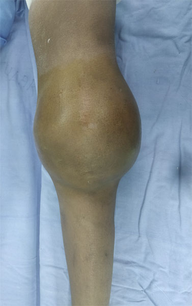 Bone tumor around the knee presenting as swelling