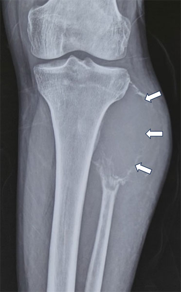 Bone tumor involving the upper fibula