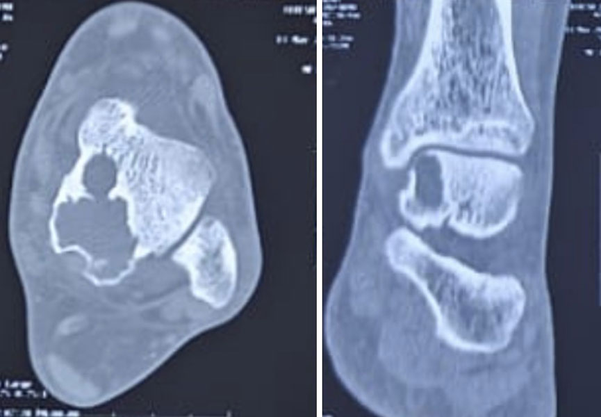 CT Scan - Understanding the bone before removing the tumour CT Scan - Understanding the bone before removing the tumour