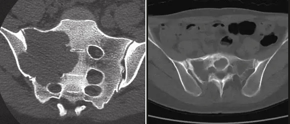 CT evaluation of a sacral tumor CT evaluation of a sacral tumor