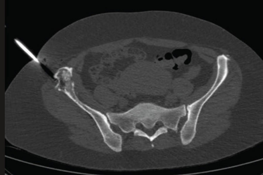 CT-guided biopsy of a pelvic bone tumor allows precise needle placement and safe tissue sampling