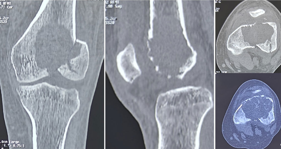 CT scan evaluation of a bone tumor around the knee