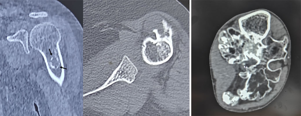 CT scan for evaluation of chondrosarcoma CT scan for evaluation of chondrosarcoma