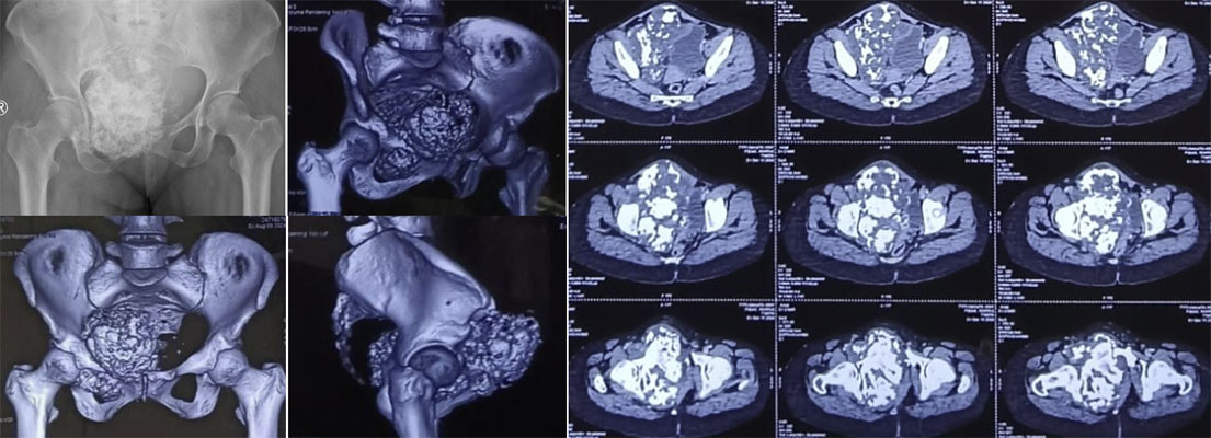 CT scan of pelvic chondrosarcoma CT scan of pelvic chondrosarcoma