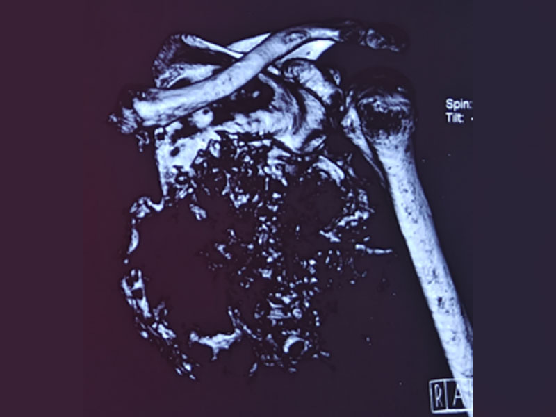 CT scan showing the extent of a scapular bone tumor, helping guide surgical planning CT scan showing the extent of a scapular bone tumor, helping guide surgical planning