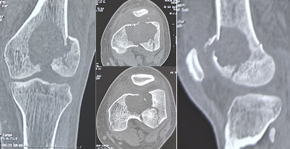 CT scan showing the extent of bone destruction caused by a giant cell tumor of bone, helping plan the appropriate surgical treatment CT scan showing the extent of bone destruction caused by a giant cell tumor of bone, helping plan the appropriate surgical treatment