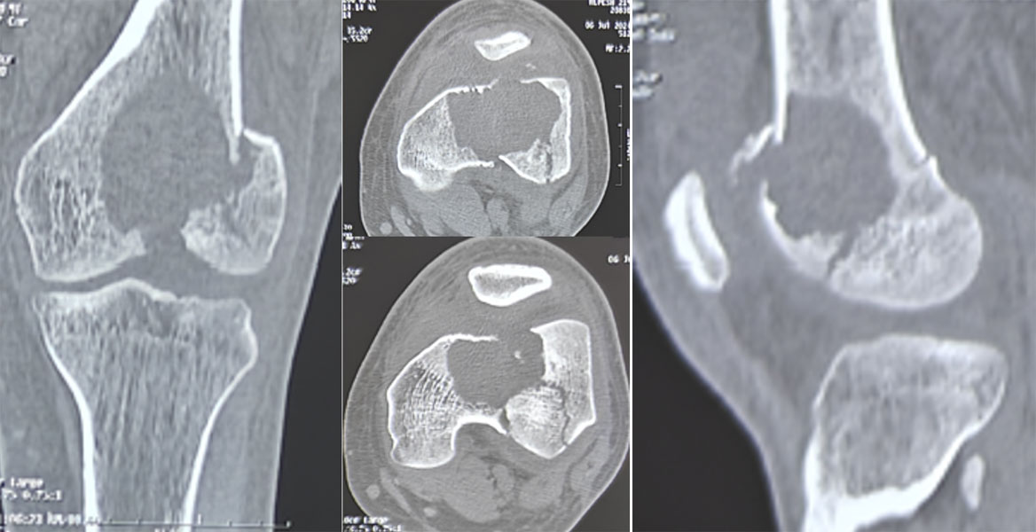 CT scan showing the extent of bone destruction caused by a giant cell tumor of bone, helping plan the appropriate surgical treatment CT scan showing the extent of bone destruction caused by a giant cell tumor of bone, helping plan the appropriate surgical treatment