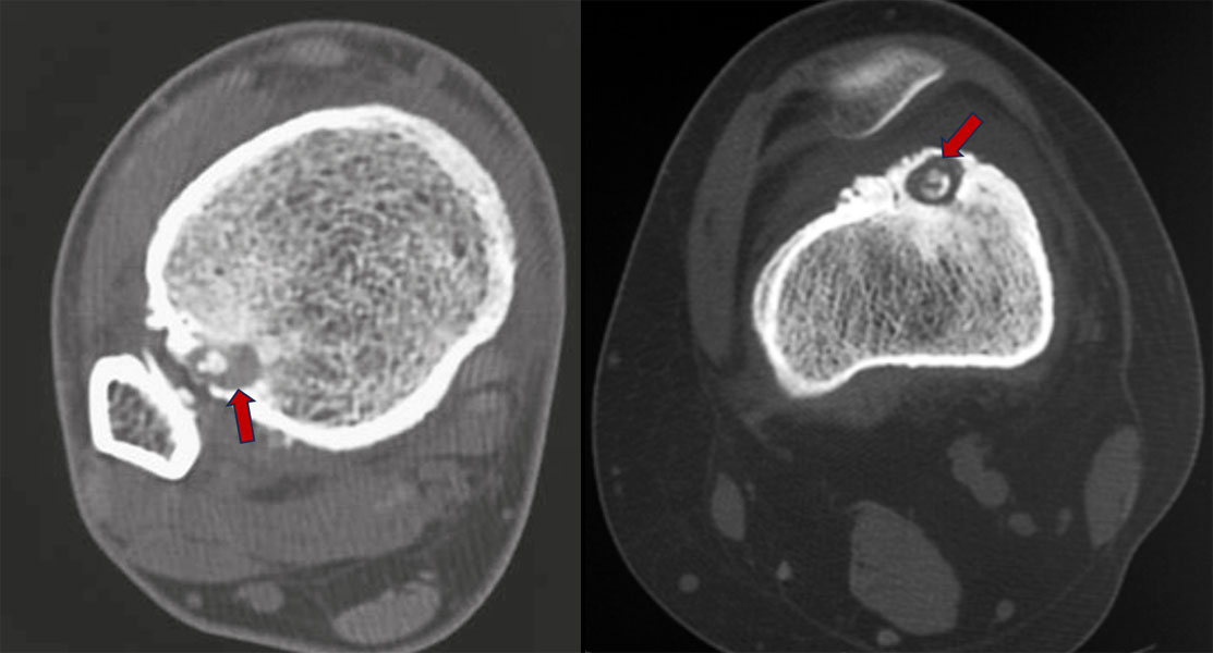 CT scan showing the nidus of an osteoid osteoma CT scan showing the nidus of an osteoid osteoma