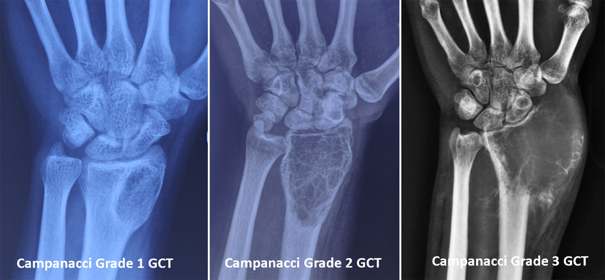 Campanacci grading of giant cell tumor of bone Campanacci grading of giant cell tumor of bone