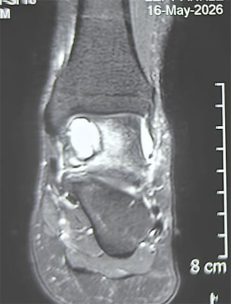 Chondroblastoma of the ankle—a benign bone tumor requiring careful evaluation and treatment planning Chondroblastoma of the ankle—a benign bone tumor requiring careful evaluation and treatment planning