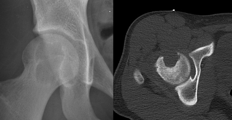 Chondroblastoma of the femoral head, a rare benign bone tumor involving the hip joint Chondroblastoma of the femoral head, a rare benign bone tumor involving the hip joint