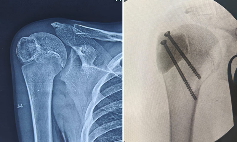 Chondroblastoma of the proximal humerus treated with extended curettage and bone cement reconstruction Chondroblastoma of the proximal humerus treated with extended curettage and bone cement reconstruction