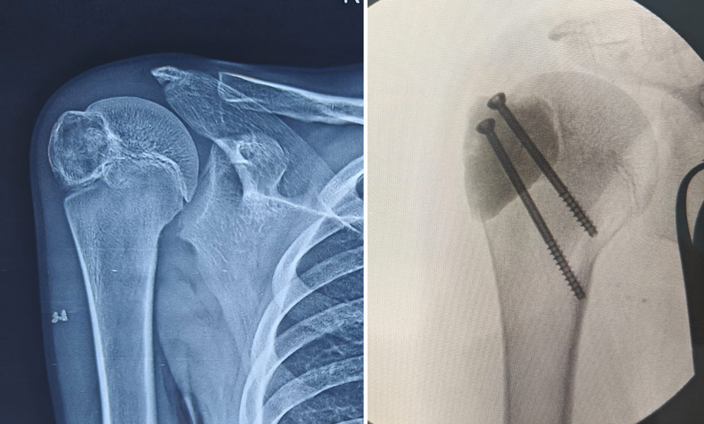 Chondroblastoma of the shoulder region Chondroblastoma of the shoulder region