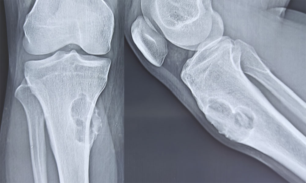 Chondromyxoid fibroma Chondromyxoid fibroma