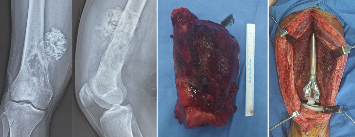 Chondrosarcoma of the lower femur treated with limb-salvage surgery Chondrosarcoma of the lower femur treated with limb-salvage surgery