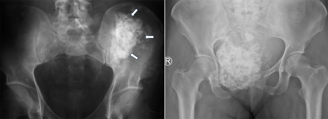 Chondrosarcoma of the pelvis Chondrosarcoma of the pelvis
