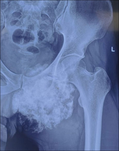 Chondrosarcoma of the pelvis Chondrosarcoma of the pelvis