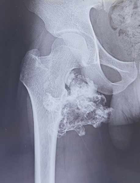 Chondrosarcoma of the proximal femur, showing a destructive cartilage-forming bone tumor Chondrosarcoma of the proximal femur, showing a destructive cartilage-forming bone tumor