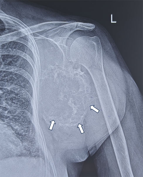 Chondrosarcoma of the shoulder blade (scapula) Chondrosarcoma of the shoulder blade (scapula)