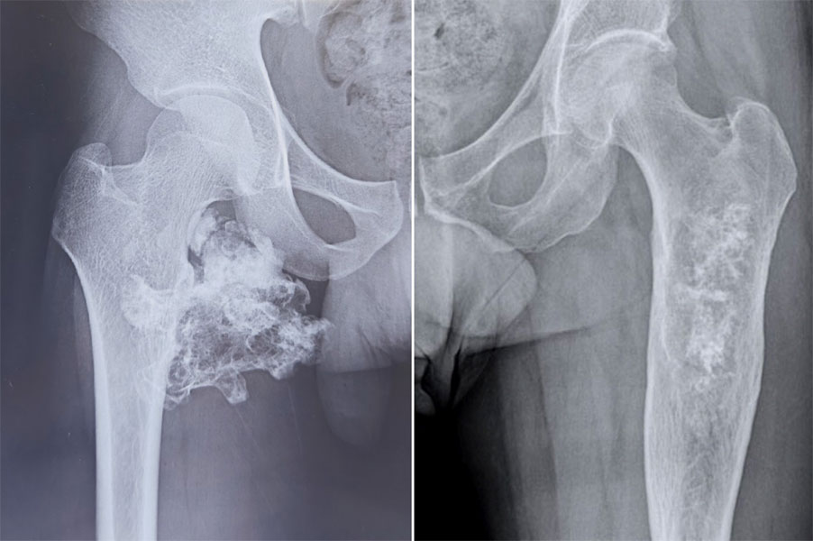 Chondrosarcoma of the thigh bone (femur) Chondrosarcoma of the thigh bone (femur)