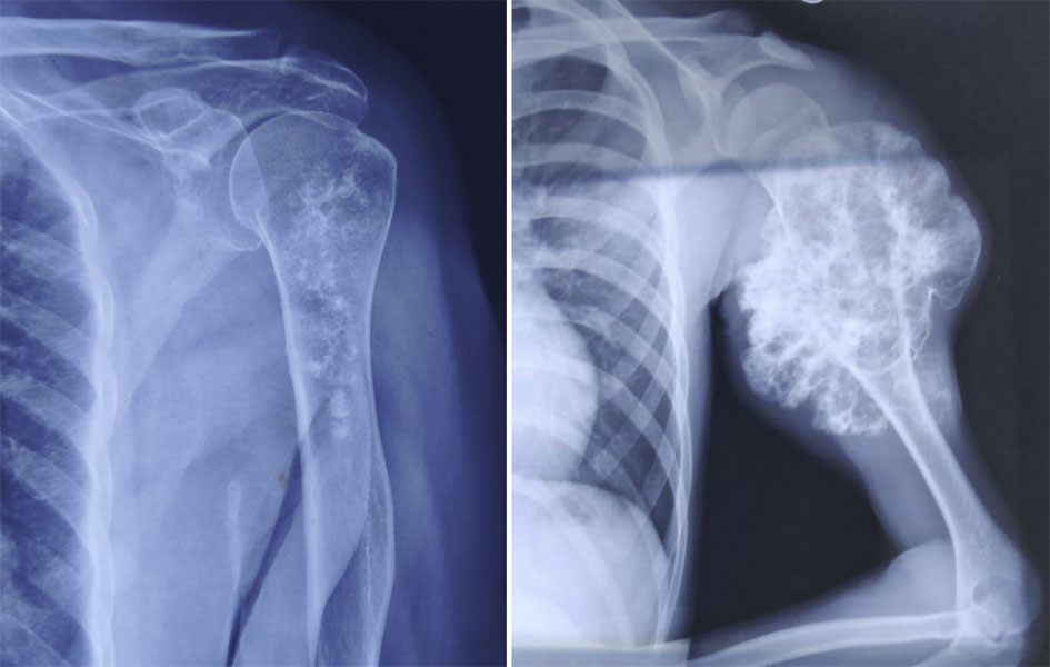 Chondrosarcoma of the upper arm bone (humerus) Chondrosarcoma of the upper arm bone (humerus)