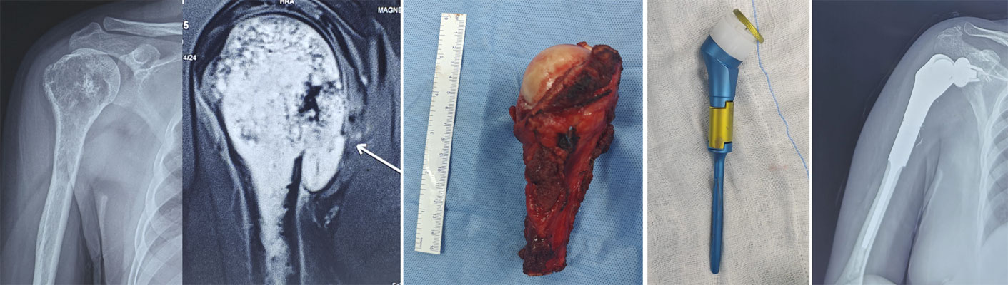 Chondrosarcoma of the upper humerus treated with limb-salvage surgery Chondrosarcoma of the upper humerus treated with limb-salvage surgery