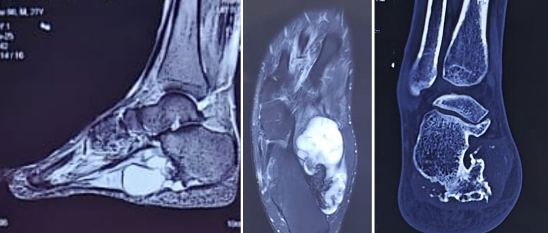 Chondrosarcoma around the ankle Chondrosarcoma around the ankle