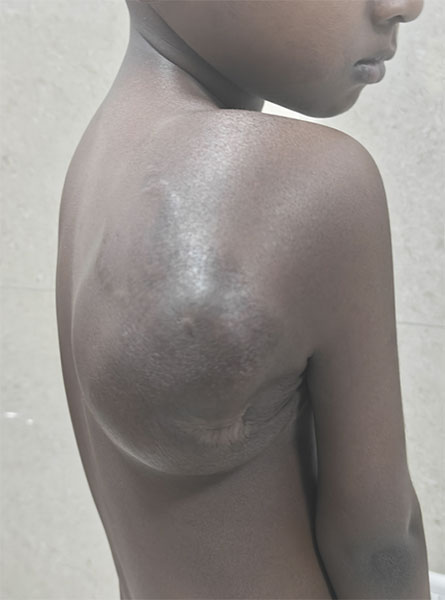 Clinical photograph showing a visible swelling caused by a scapular bone tumor Clinical photograph showing a visible swelling caused by a scapular bone tumor