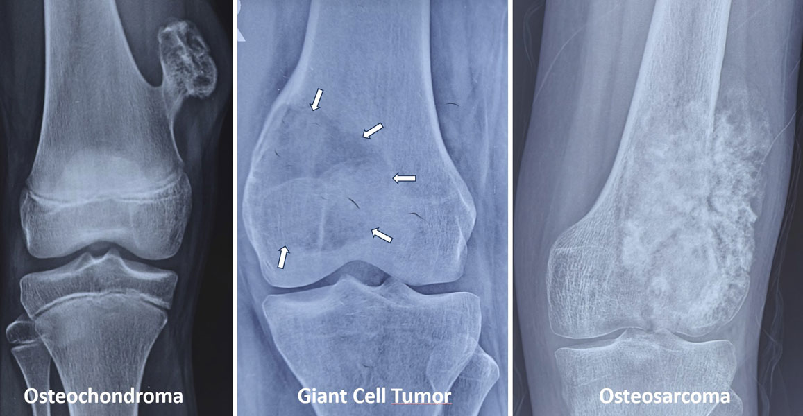 Common bone tumors involving the lower femur