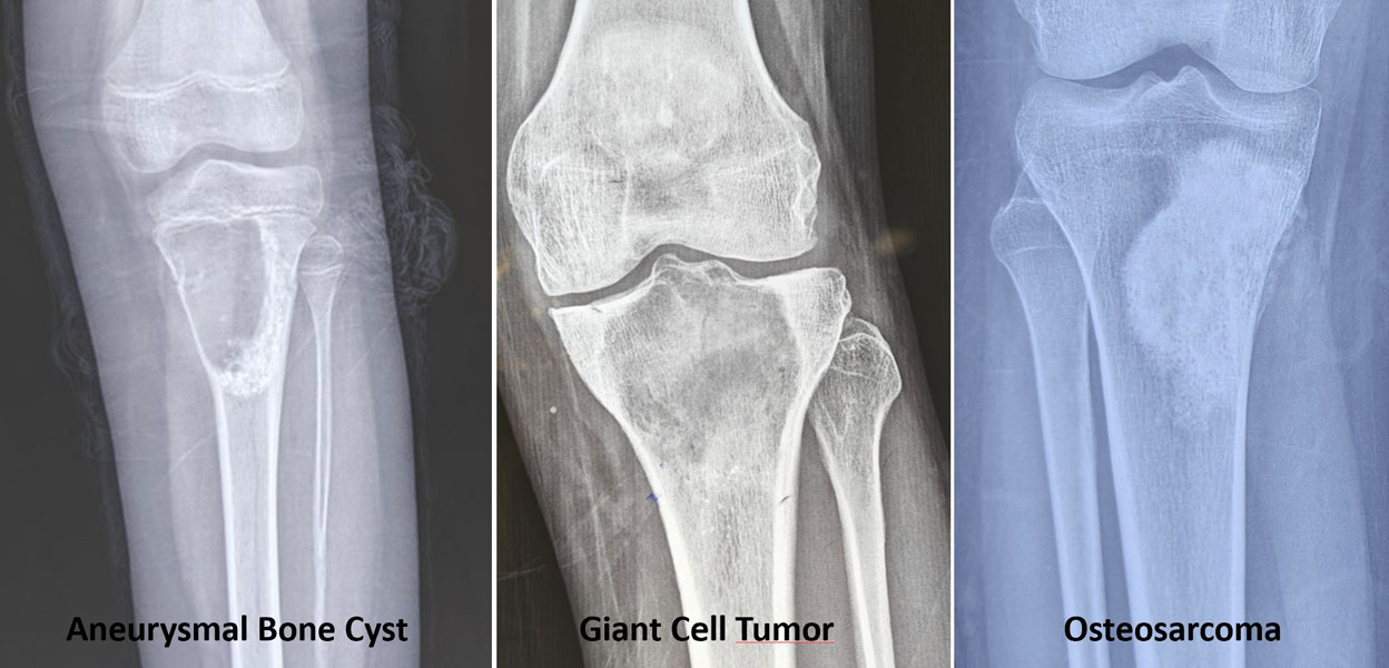 Common bone tumors involving the upper tibia