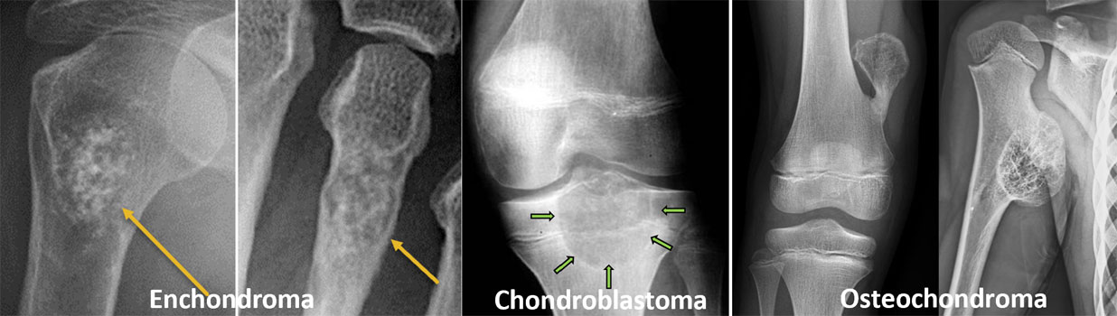 Common cartilage-forming bone tumors Common cartilage-forming bone tumors