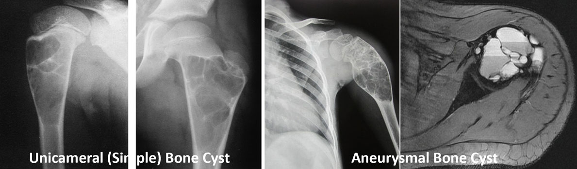 Common types of bone cysts Common types of bone cysts