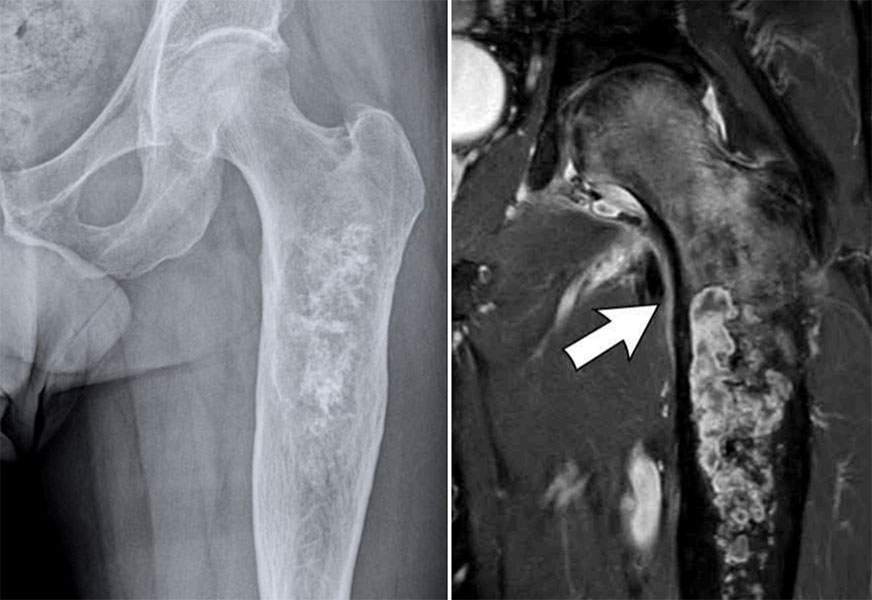 Conventional chondrosarcoma of the proximal femur Conventional chondrosarcoma of the proximal femur