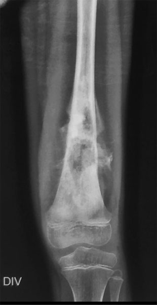 Conventional osteosarcoma Conventional osteosarcoma
