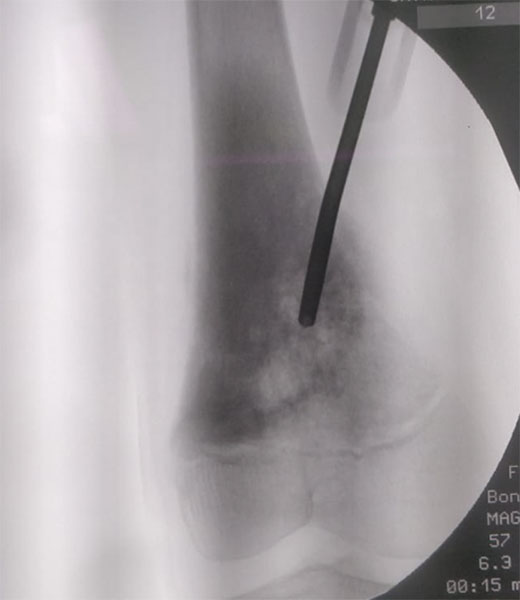 Core needle biopsy of a bone tumor using a biopsy needle to obtain tissue samples for diagnosis