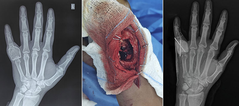Curettage of a giant cell tumor of the hand Curettage of a giant cell tumor of the hand